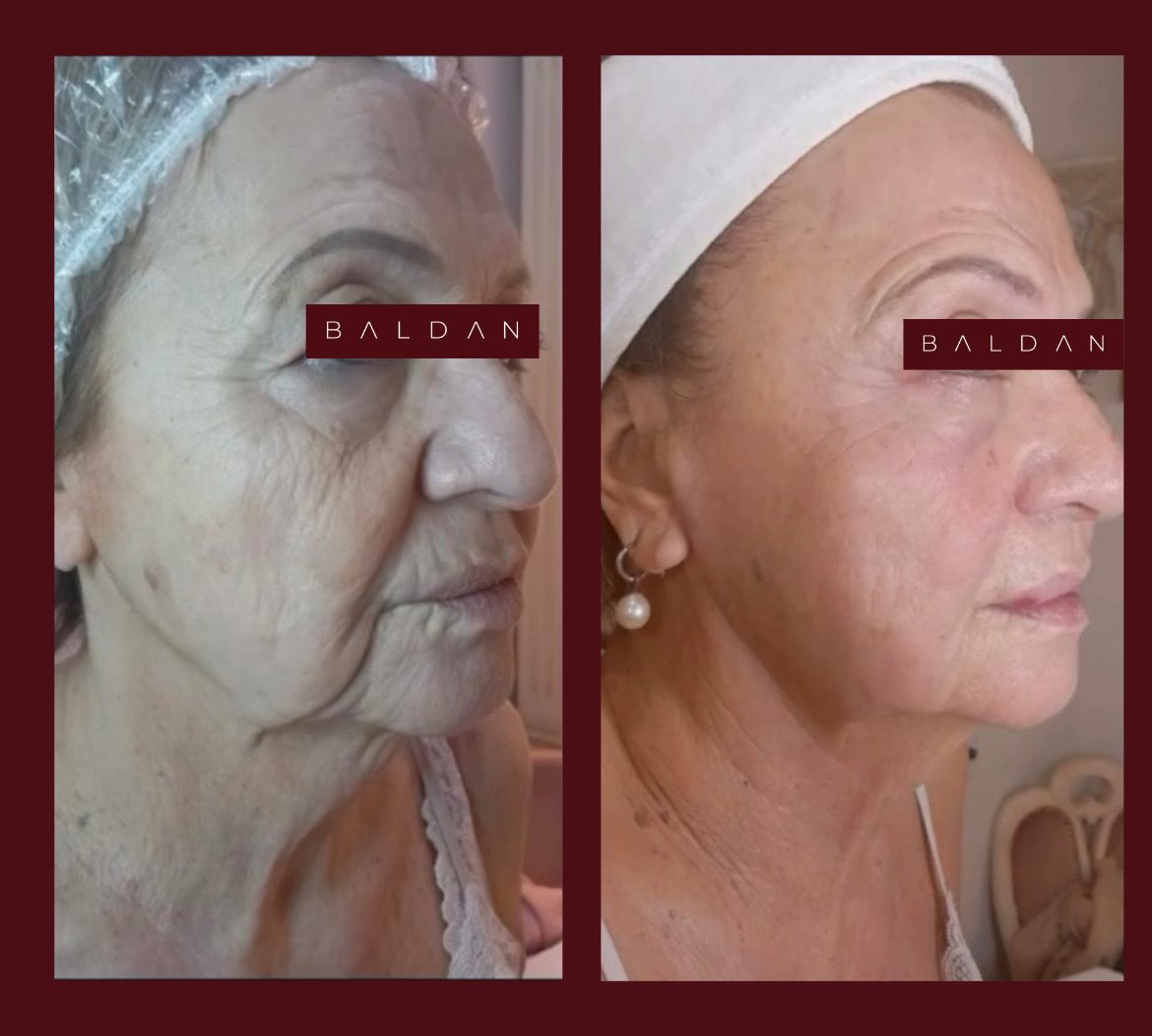 T-Face before and after result