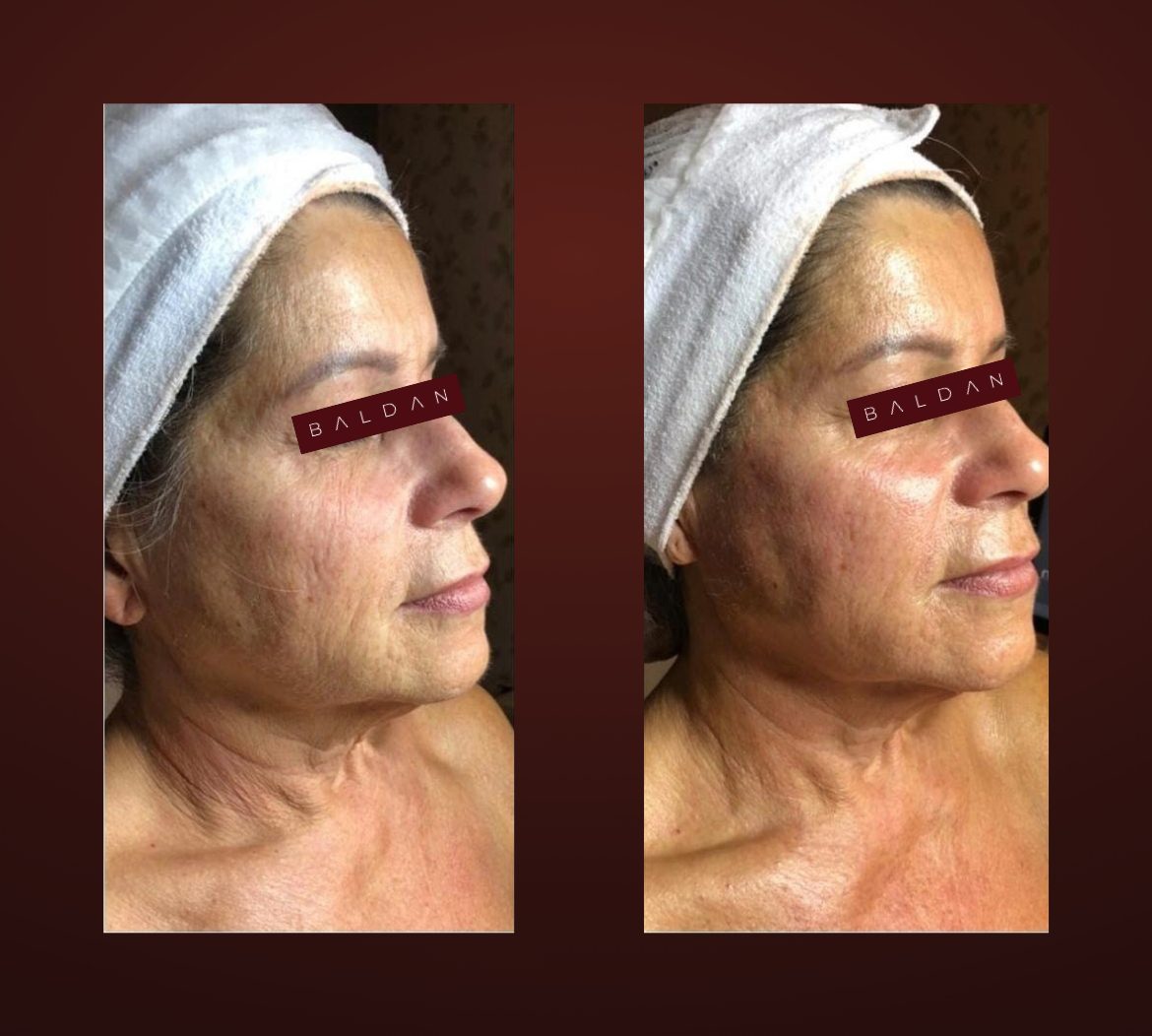 T-Face before and after — full face