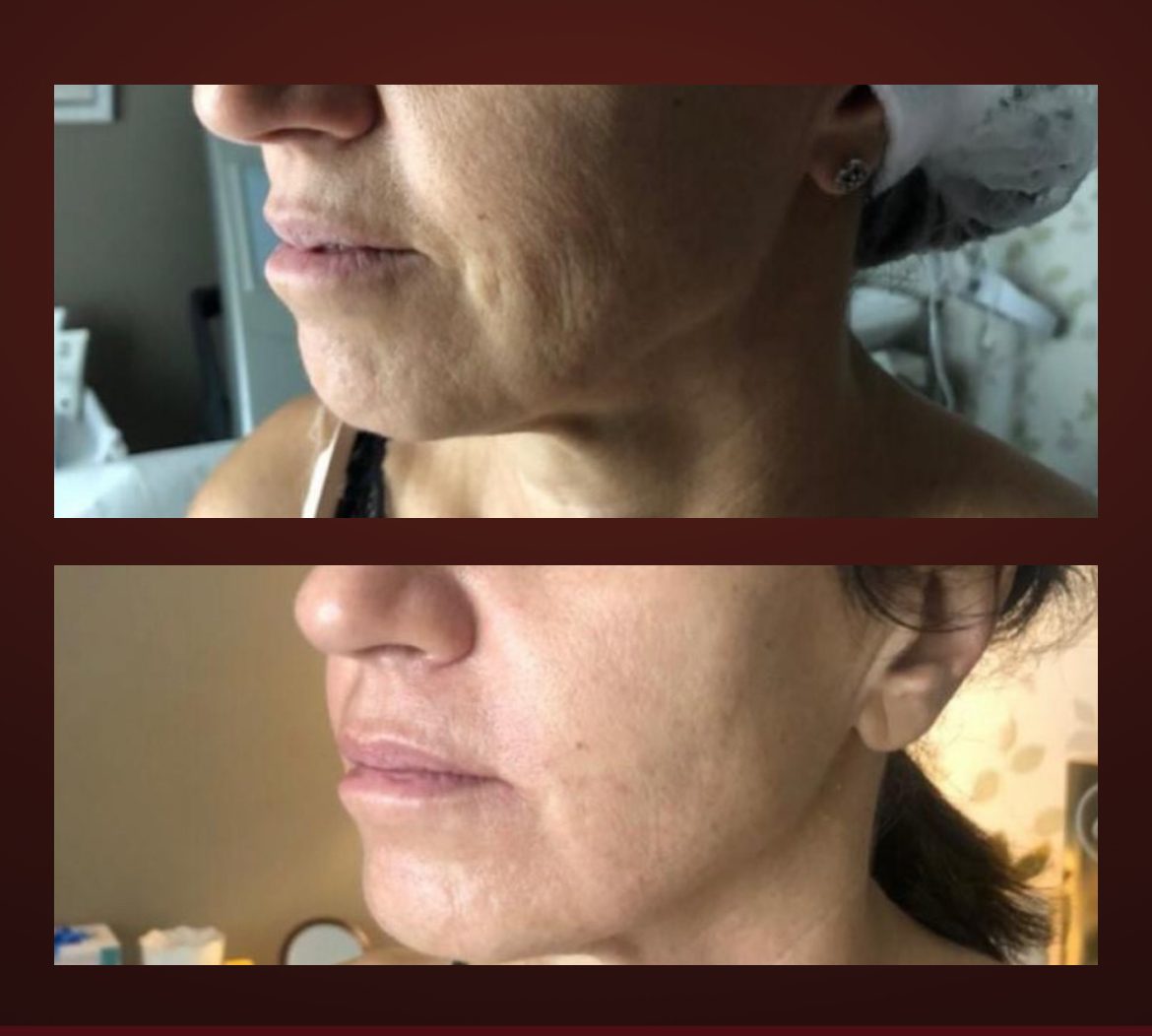 T-Face before and after — chin and neck