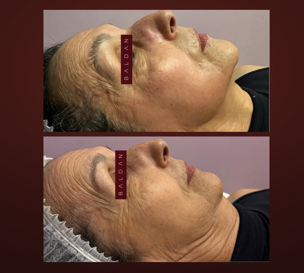 T-Face before and after — profile