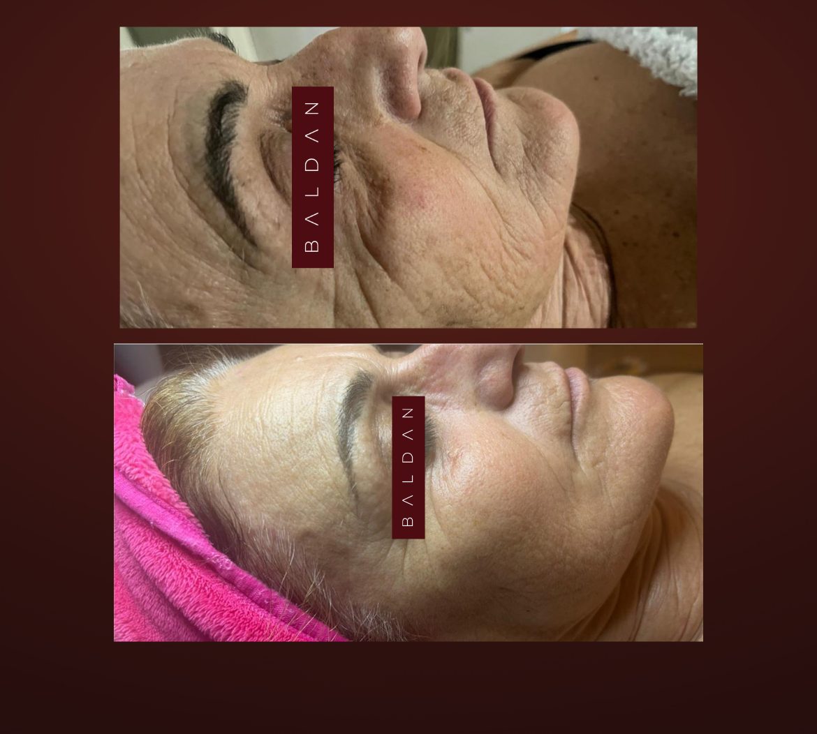 T-Face before and after — cheeks