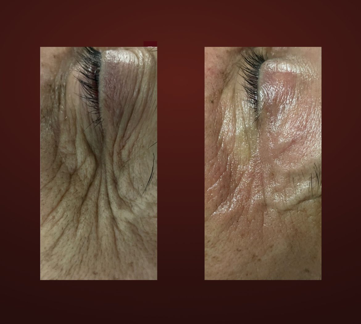 T-Face before and after — eye area